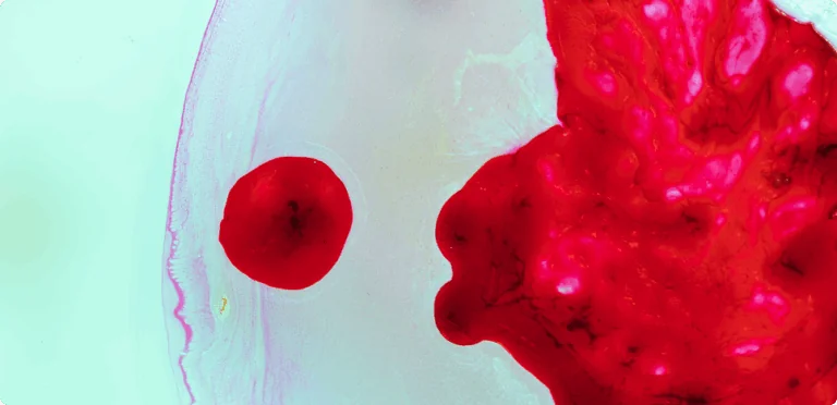 Transforming Dried Blood Spot Analysis with Metabolomics